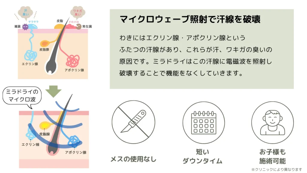 ミラドライの施術説明