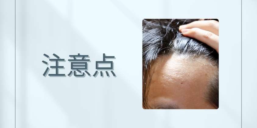 フィナステリドを生え際対策に用いる際の注意点