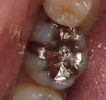 銀歯のイメージ