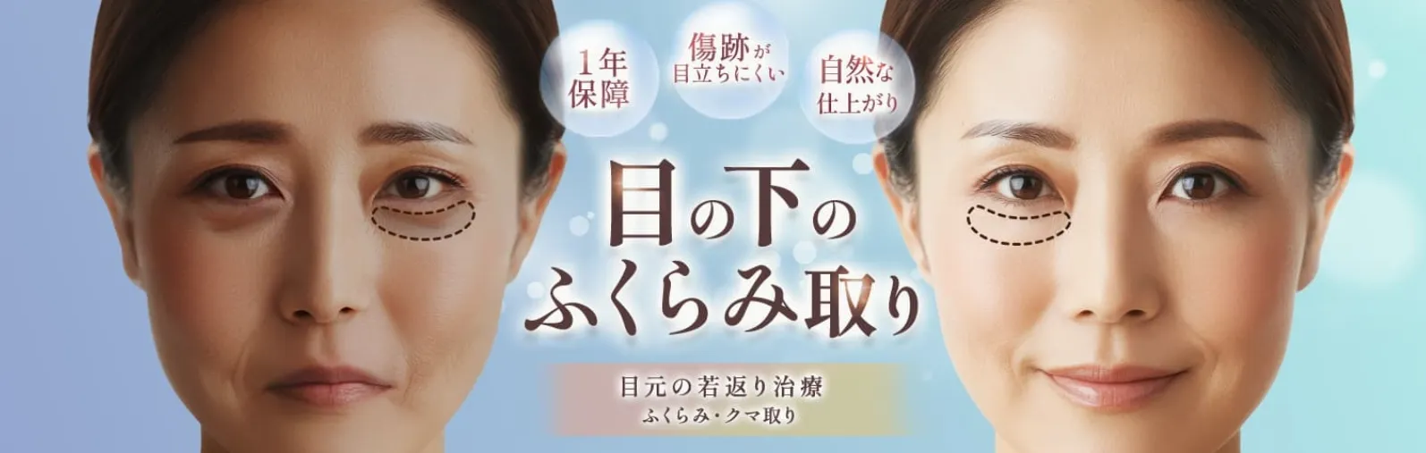 品川美容外科 目の下のふくらみ取り
